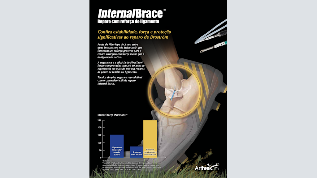 InternalBrace™ Reparo com reforço do ligamento