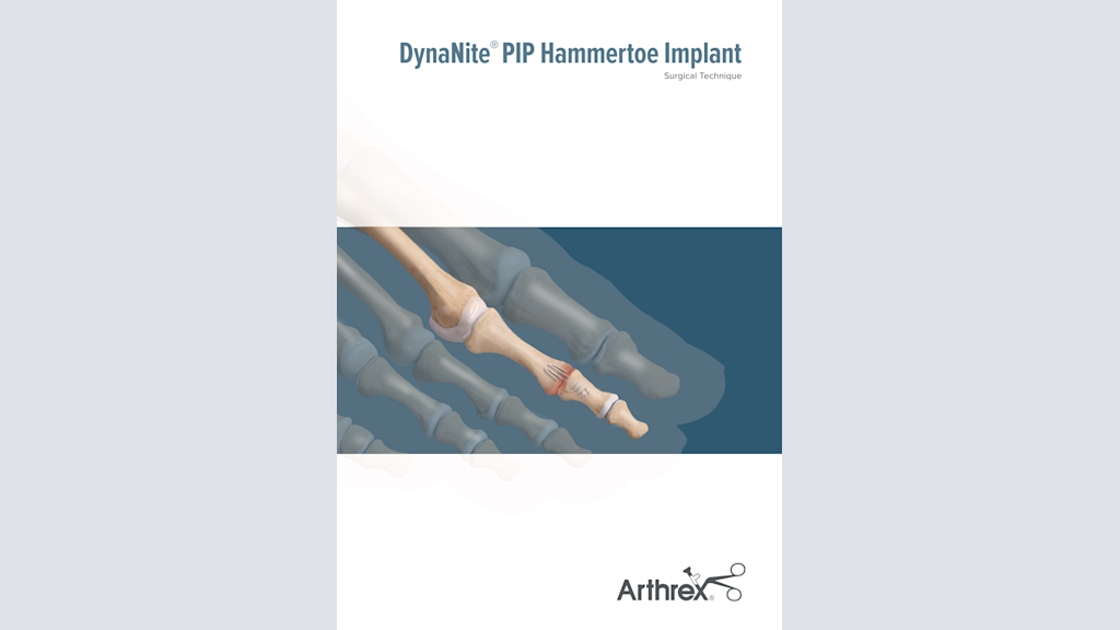 DynaNite® PIP Hammertoe Implant