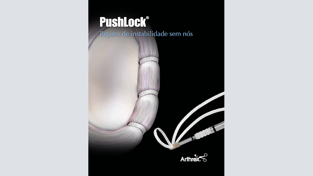 PushLock® - Reparo de inestabilidade sem nós