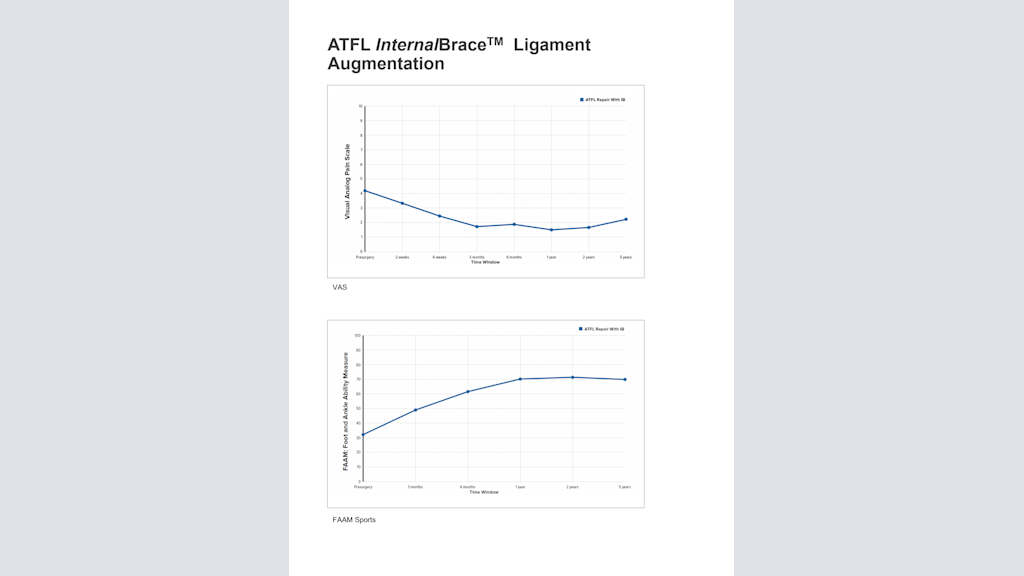 ATFL InternalBrace™ Ligament Augmentation