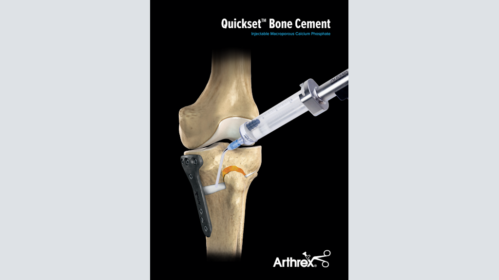Quickset™ Bone Cement - Injectable Macroporous Calcium Phosphate