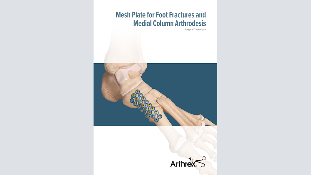 Mesh Plate for Foot Fractures and Medial Column Arthrodesis