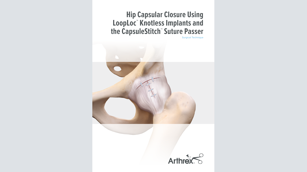 Hip Capsular Closure Using The LoopLoc™ Knotless Implant and the CapsuleStitch™ Suture Passer