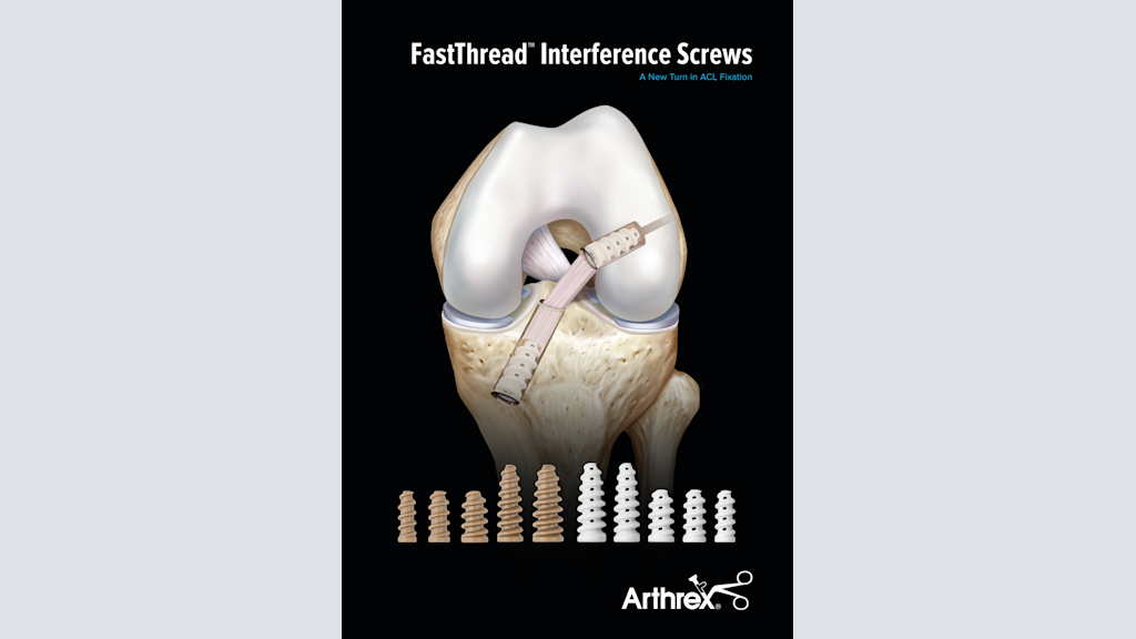FastThread™ Interference Screws A New Turn in ACL Fixation