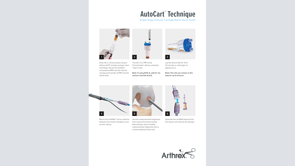 AutoCart™ Technique - Single-Stage Articular Cartilage Repair Quick Guide