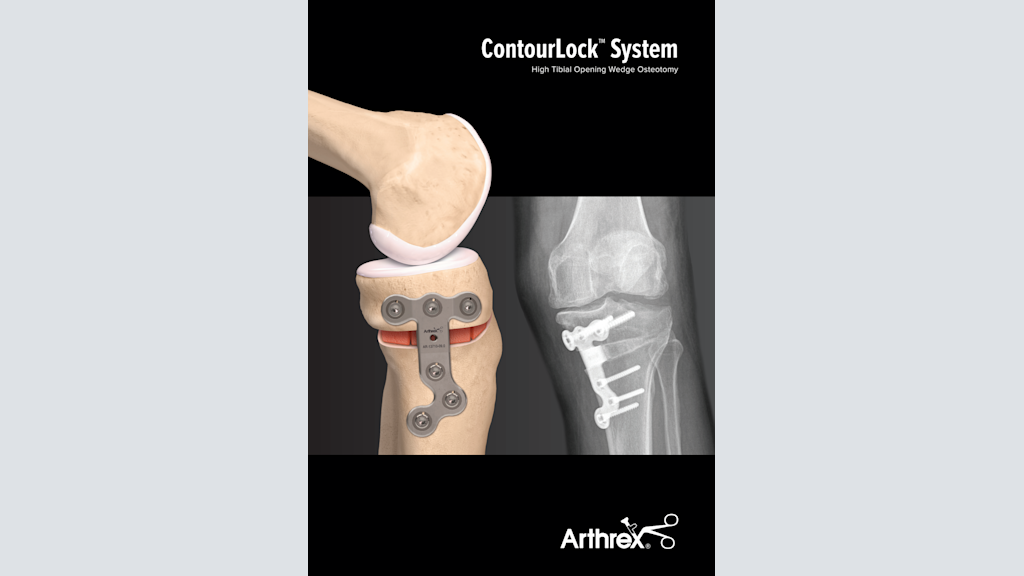ContourLock® High Tibial Opening Wedge Osteotomy System