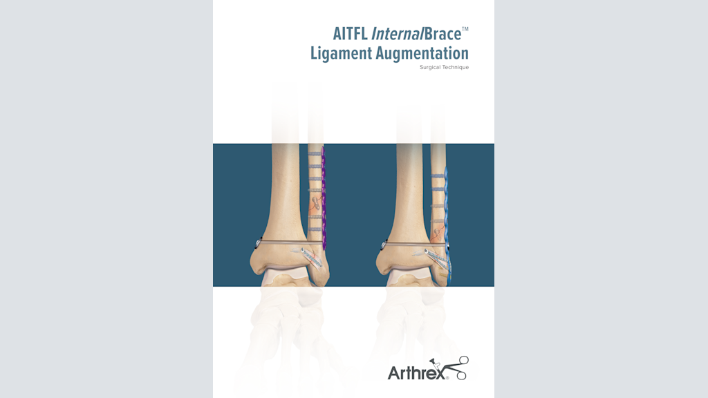 AITFL InternalBrace™ Ligament Augmentation
