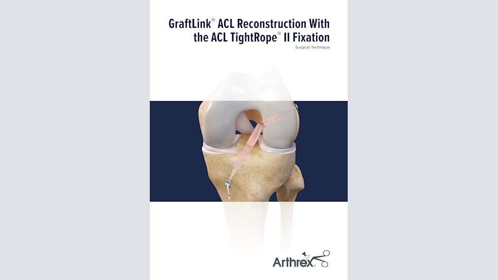 GraftLink® ACL Reconstruction With the ACL TightRope® II Fixation