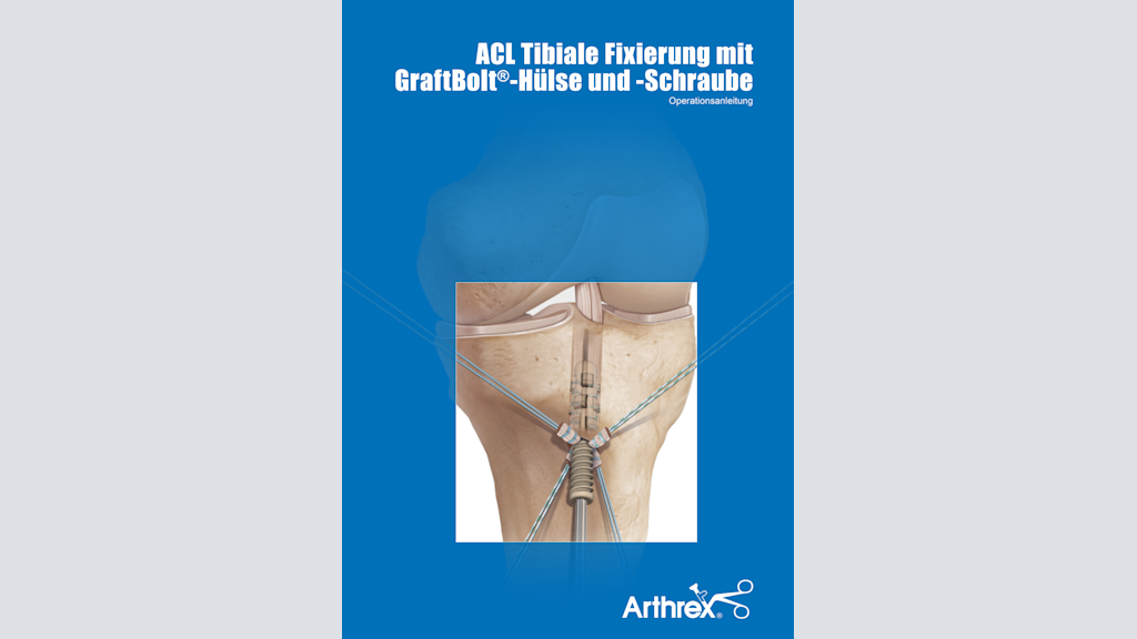 ACL Tibiale Fixierung mit GraftBolt®-Hülse und -Schraube