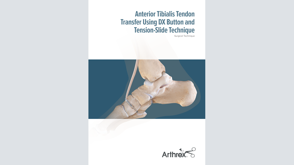 Anterior Tibialis Tendon Transfer Using DX Button and Tension-Slide Technique
