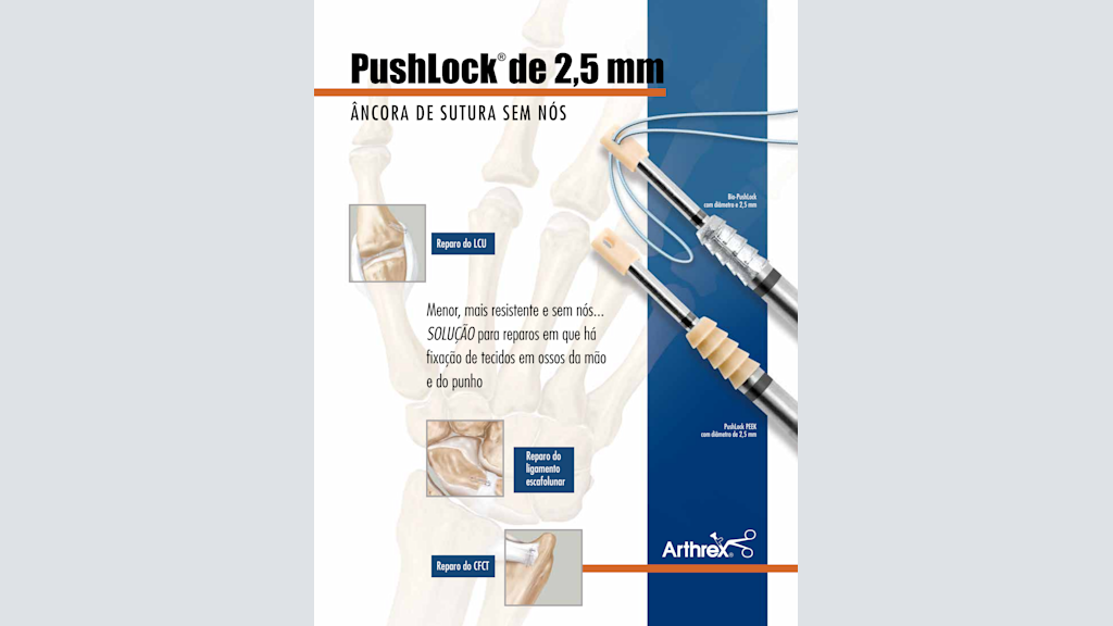 PushLock® de 2,5 mm - Âncora de sutura sem nós