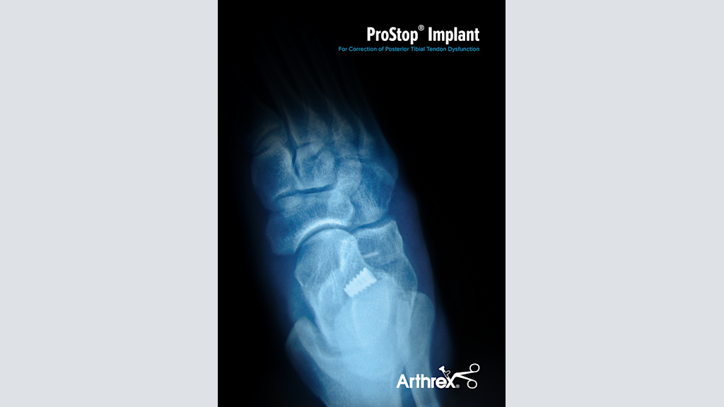 ProStop® Implant For Correction of Posterior Tibial Tendon Dysfunction