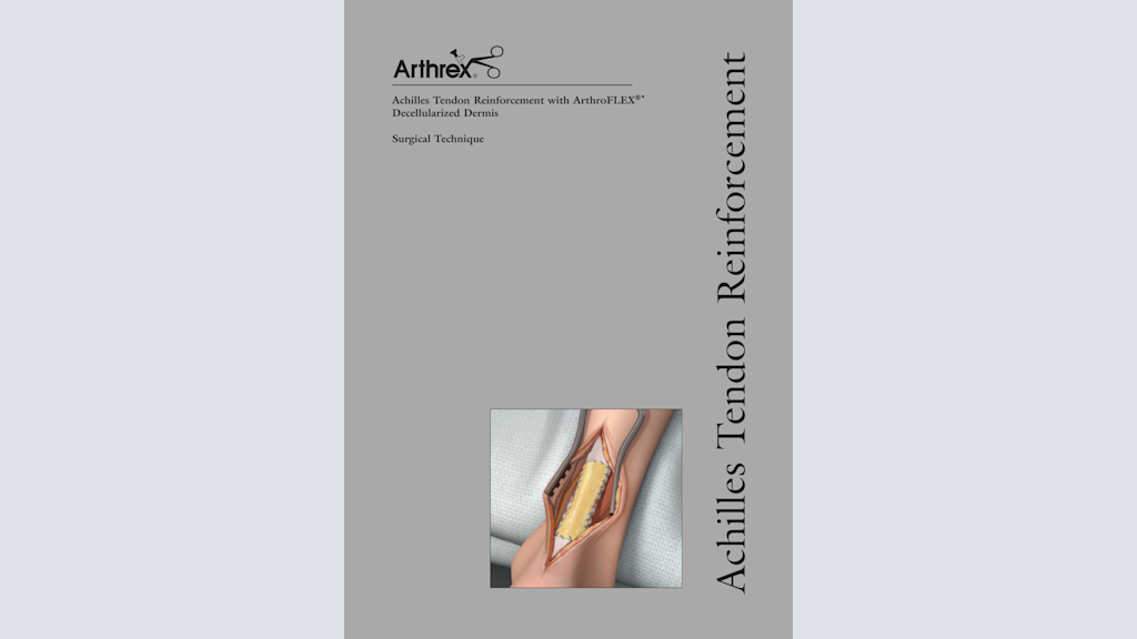Achilles Tendon Reinforcement with ArthroFlex® Decellularized Dermis