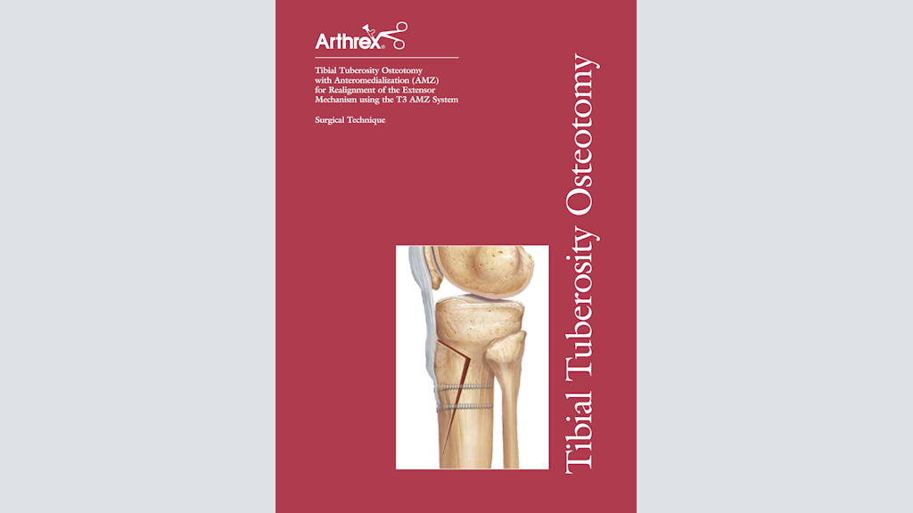 Tibial Tuberosity Osteotomy with Anteromedialization (AMZ) for Realignment of the Extensor Mechanism using the T3 AMZ System
