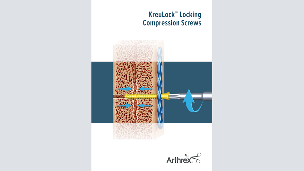 KreuLock™ Locking Compression Screws
