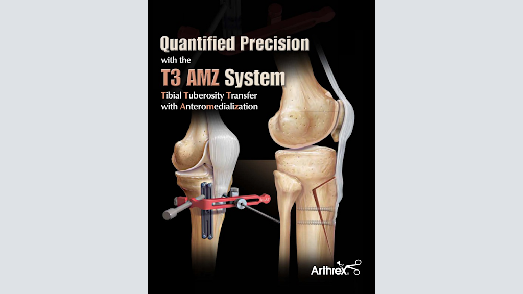 Quantified Precision with the T3 AMZ System - Tibial Tuberosity Transfer with Anteromedialization