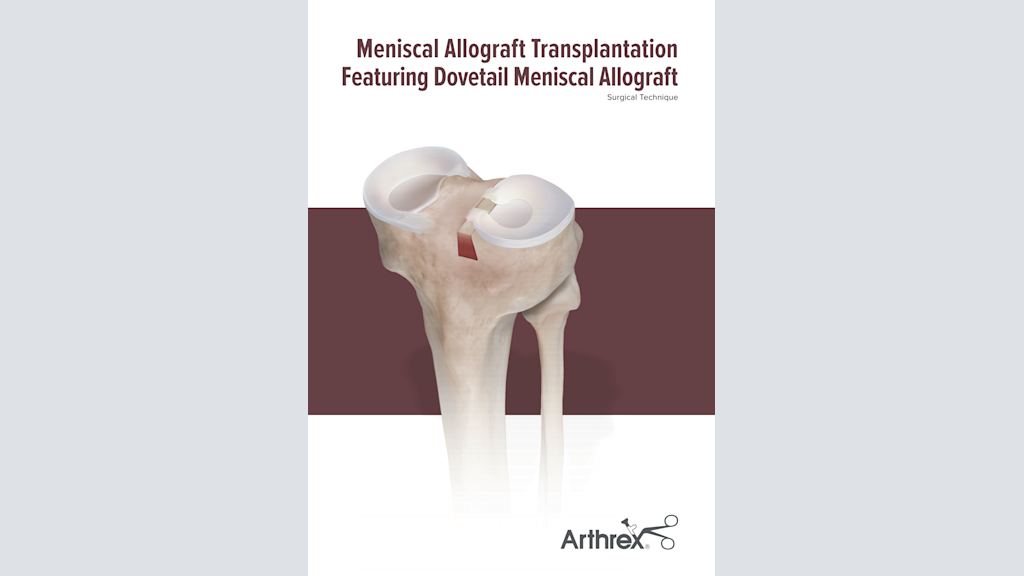 Meniscal Allograft Transplantation Featuring Dovetail Meniscal Allograft