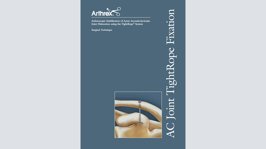 Arthroscopic Stabilization of Acute Acromioclavicular Joint Dislocation using the TightRope® System