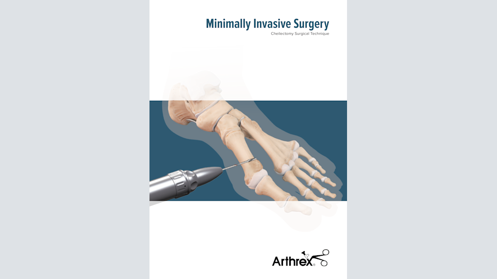 Minimally Invasive Surgery - Cheilectomy Surgical Technique
