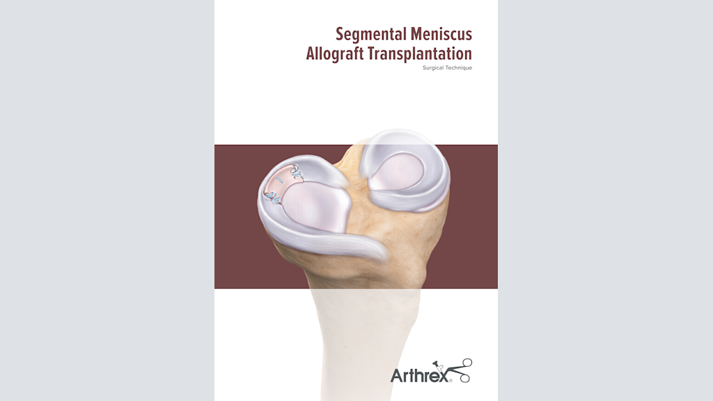 Segmental Meniscus Allograft Transplantation
