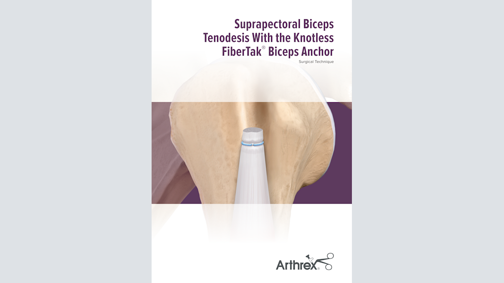 Suprapectoral Biceps Tenodesis With the Knotless FiberTak®  Biceps Anchor