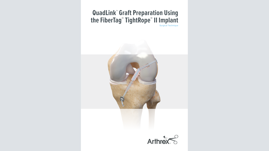 QuadLink™ Graft Preparation Using the FiberTag® TightRope® II Implant
