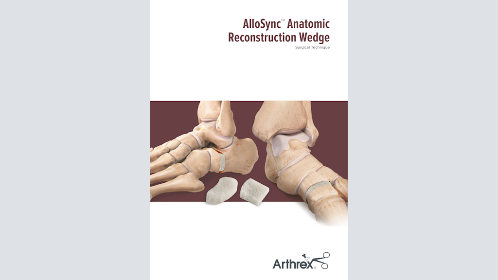 AlloSync™ Anatomic Reconstruction Wedge