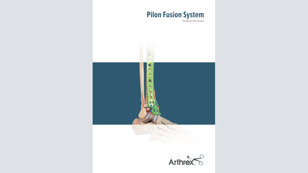 Pilon Fusion System