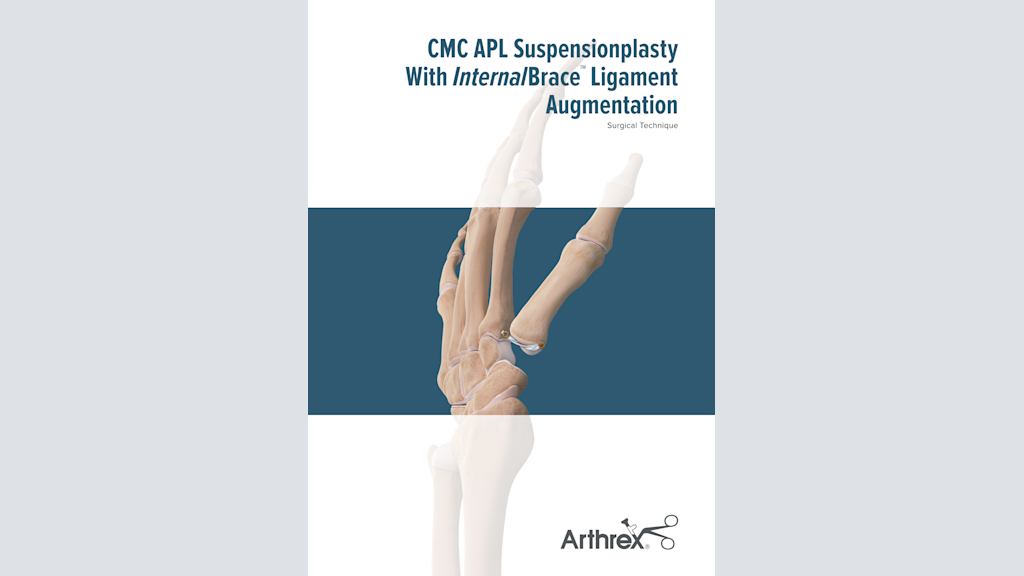 CMC APL Suspensionplasty With InternalBrace™ Ligament Augmentation