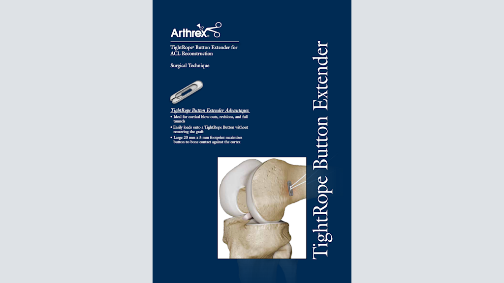 TightRope® Button Extender for ACL Reconstruction