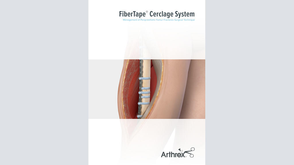 FiberTape® Cerclage System Management of Periprosthetic Femur Fractures Surgical Technique