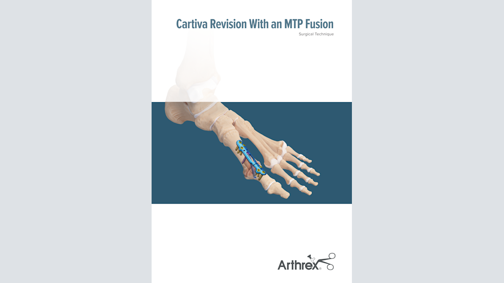 Cartiva Revision With an MTP Fusion Surgical Technique