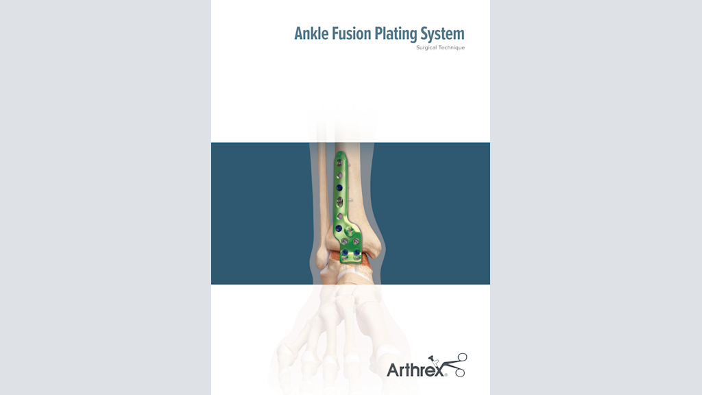 Ankle Fusion Plating System