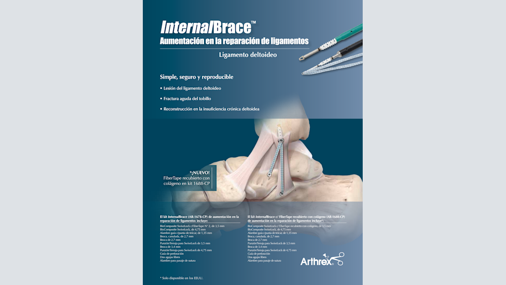 InternalBrace™ - Aumentación en la reparación de ligamentos - Ligamento deltoideo