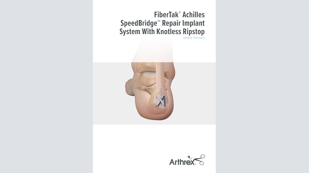 FiberTak® Achilles SpeedBridge™ Repair Implant System With Knotless Ripstop