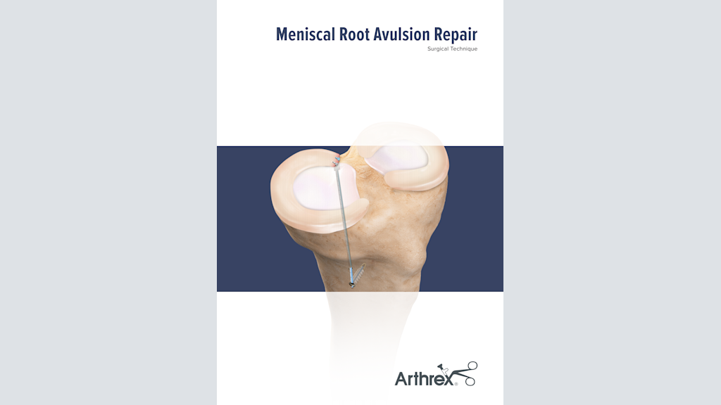 Meniscal Root Avulsion Repair