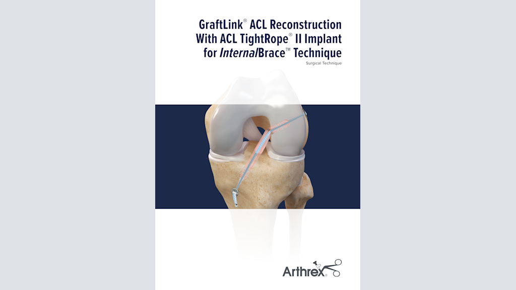 GraftLink®  ACL Reconstruction  With ACL TightRope®  II Implant  for InternalBrace™ Technique