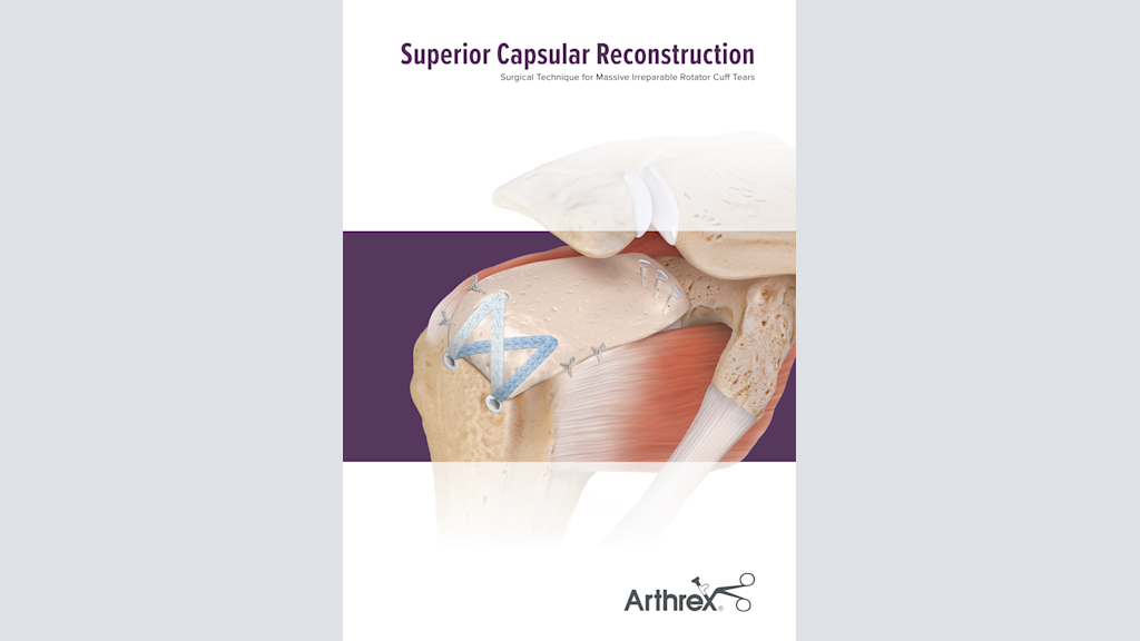 Superior Capsular Reconstruction Surgical Technique for Massive Irreparable Rotator Cuff Tears