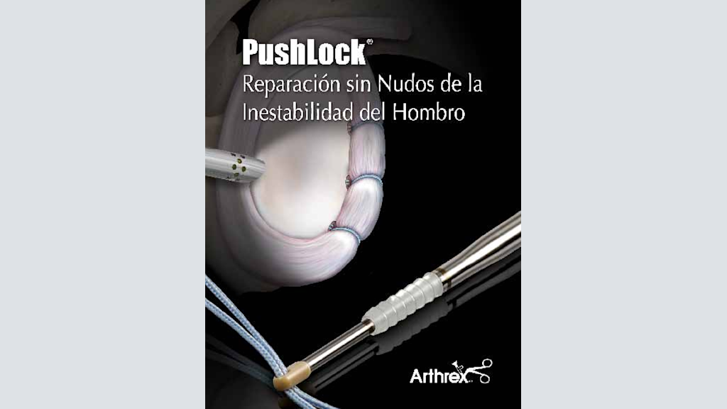 PushLock® - Reparación sin Nudos de la Inestabilidad del Hombro