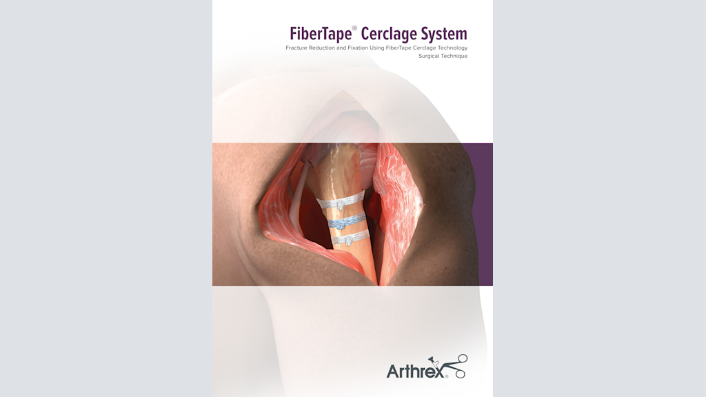 FiberTape® Cerclage System Fracture Reduction and Fixation Using FiberTape Cerclage Technology