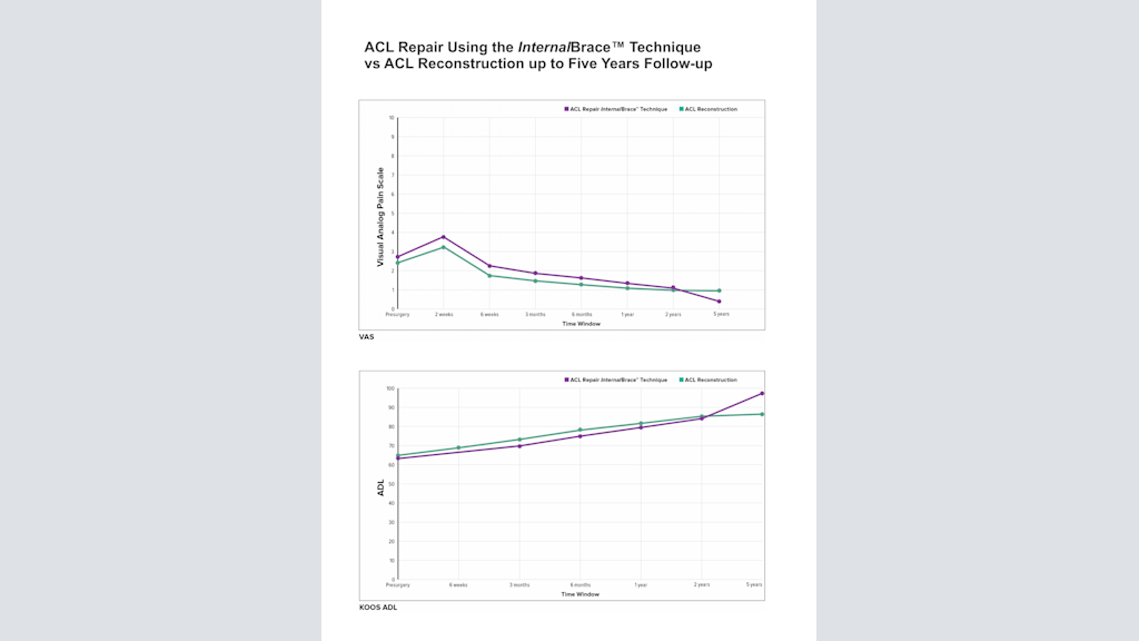 ACL Repair with InternalBrace™ Ligament Augmentation vs. ACL Reconstruction up to Two Years Follow-up