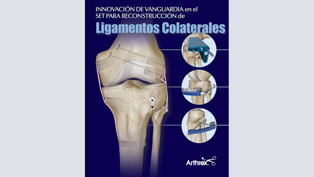 Innovación de vanguardia en el set para reconstrucción de ligamentos colaterales