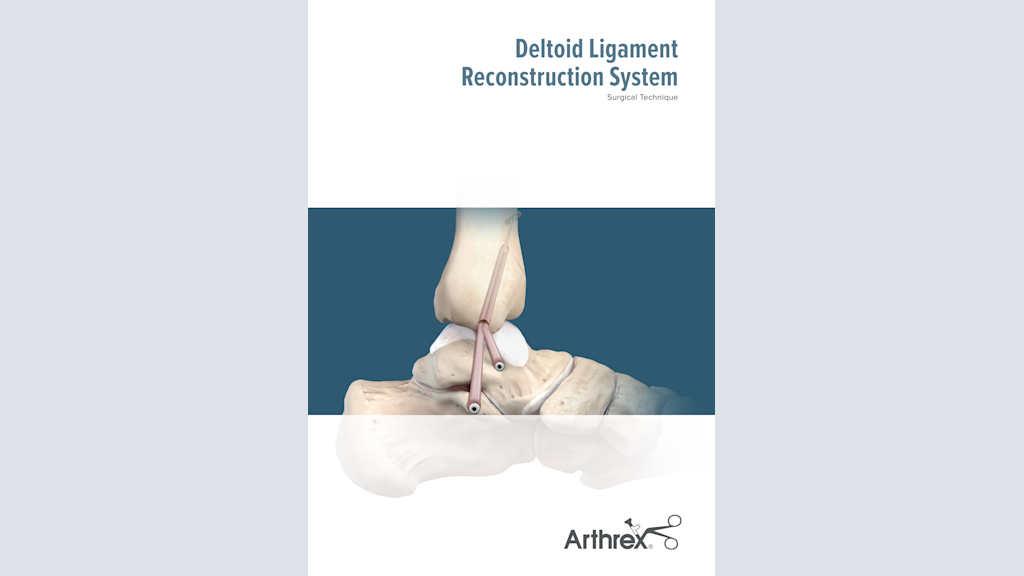 Deltoid Ligament Reconstruction System