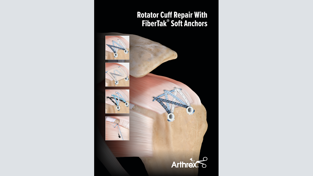Rotator Cuff Repair with FiberTak® Soft Anchors