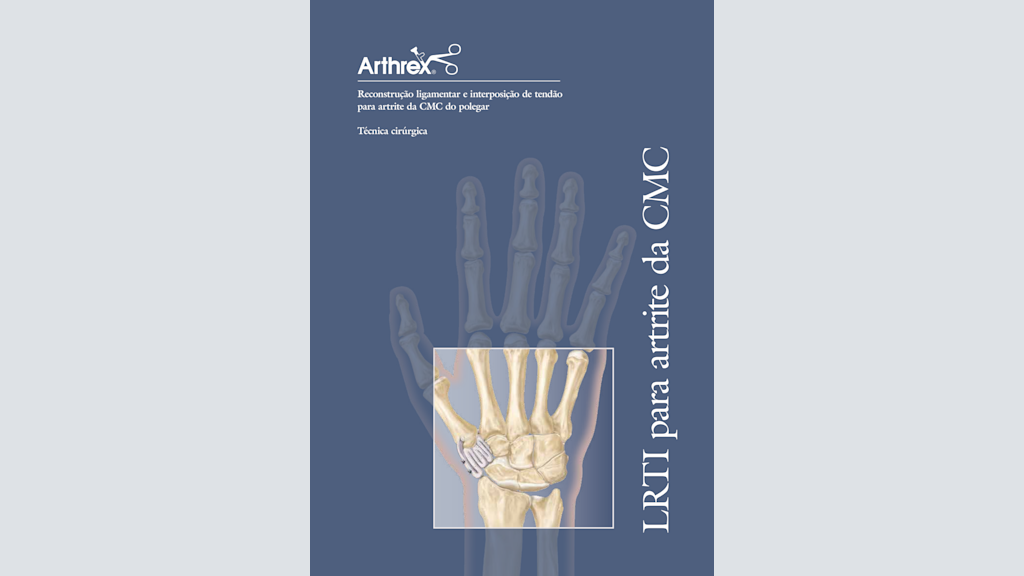 Reconstrução ligamentar e interposição de tendão para artrite da CMC do polegar
