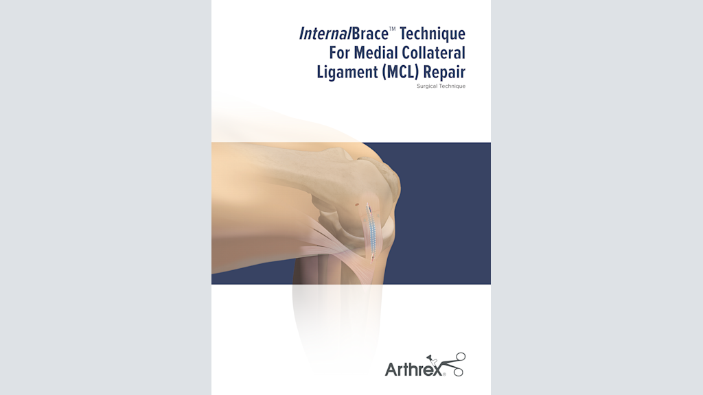 InternalBrace™ Technique For Medial Collateral Ligament (MCL) Repair
