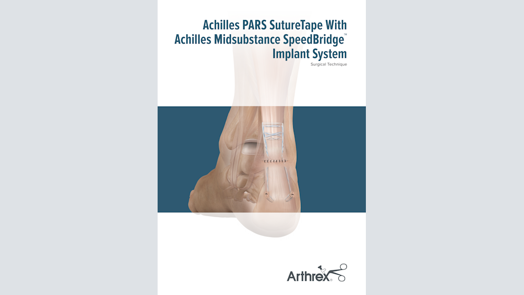 Achilles PARS SutureTape With Achilles Midsubstance SpeedBridge™ Implant System
