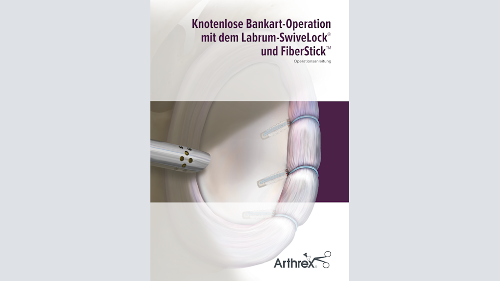 Knotenlose Bankart-Operation mit dem Labrum-SwiveLock® und FiberStick™