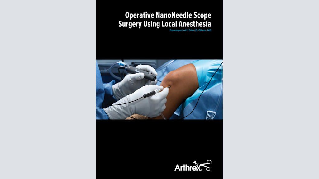 Operative NanoNeedle Scope Surgery Using Local Anesthesia