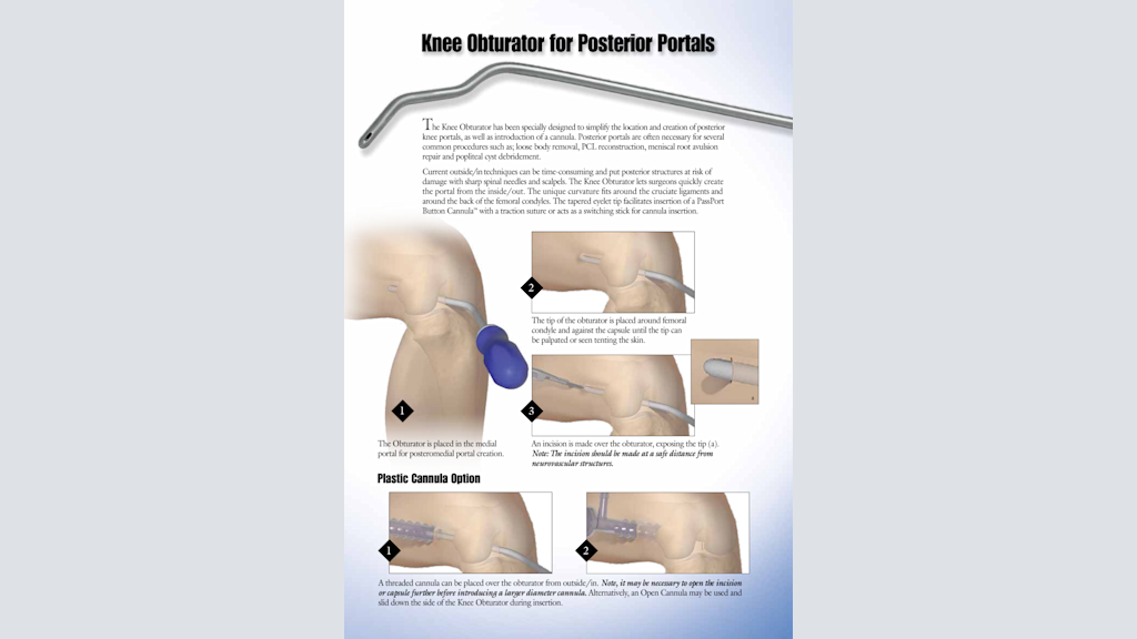 Knee Obturator for Posterior Portals